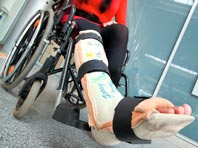 Курение препятствует заживлению переломов, показало исследование