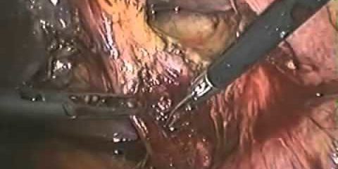 Лапароскопический билиодигестивный анастомоз