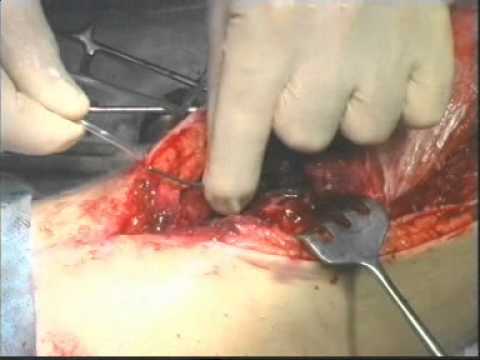 Остеомиелит бедренной кости — osteomielit femur