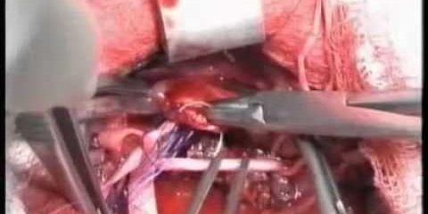 Шунтирующие операции на сонной артерии