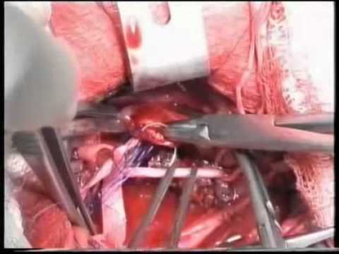 Шунтирующие операции на сонной артерии