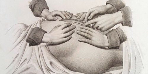 Почему врачи предпочитают кесарево сечение — МедНовости