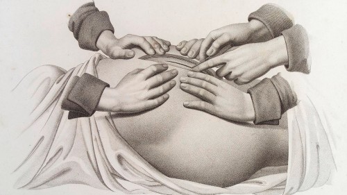 Почему врачи предпочитают кесарево сечение — МедНовости