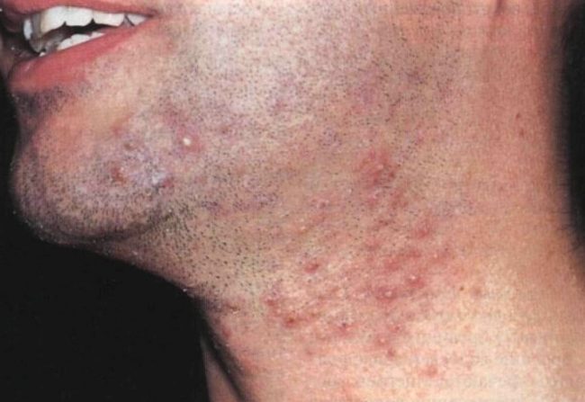 Как избавиться от проблемы вросших волос