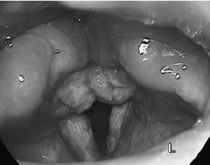Рис. 3. Ларингоскопическая картина хронического гиперпластического ларингита у пациента с рефлюкс-эзофагитом 