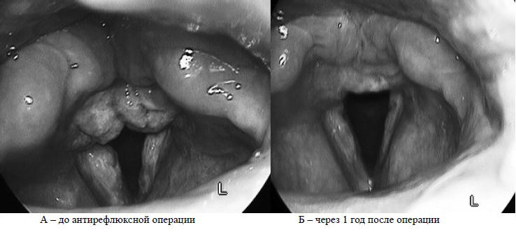 Рис. 9. Ларингоскопическая картина хронического гиперпластического ларингита у пациента с рефлюкс-эзофагитом 