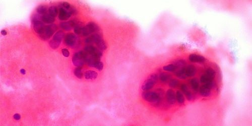 Рак молочной железы: 5 признаков помимо уплотнений в груди