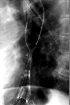 Рис. 2. Рентгенограмма кардиальной грыжи пищеводного отверстия диафрагмы, боковая проекция. а — область стриктуры 