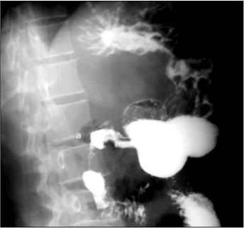 Рис. 4. Рентгенограмма рубцовой деформации двенадцатиперстной кишки (а), косая проекция 