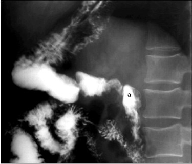 Рис. 5. Рентгенограмма дивертикула двенадцатиперстной кишки, косая проекция. а — дивертикул двенадцатиперстной кишки 