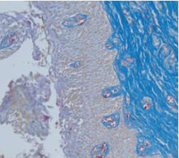Рис. 3. Гистологическое исследование биоптата: выраженный склероз в подслизистом слое (окраска гематоксилином Маллори, ×200) 