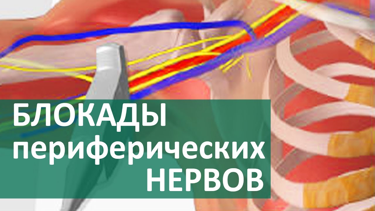 Блокада нерва. Блокада периферического нерва. Проводниковая блокада периферических нервов.