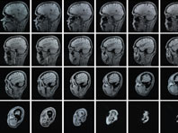 Онкологи взяли на вооружение «умный вирус», видящий только раковые клетки