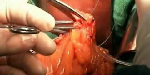 Резекция сигмовидной кишки