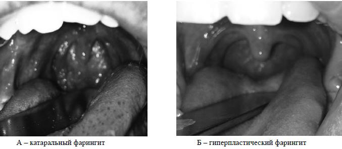 Рис. 2 Картина фарингоскопии у пациентов с гастроэзофагеальной рефлюксной болезнью до операции 