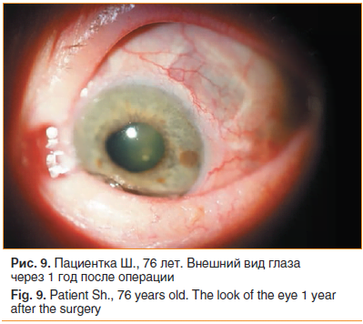 Рис. 9. Пациентка Ш., 76 лет. Внешний вид глаза через 1 год после операции