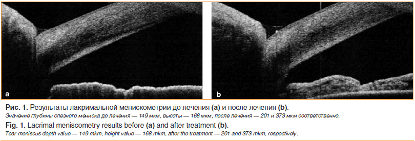 Рис. 1. Результаты лакримальной менискометрии до лечения (a) и после лечения (b).