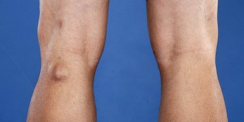 4 симптома тромбоза подколенной вены