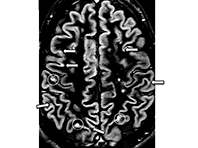 Эксперты опробовали препарат против усыхания мозга