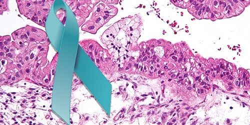 Это нужно знать, чтобы не пропустить рак яичника — МедНовости