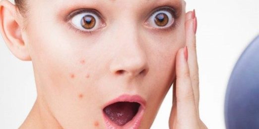 «Чистое» питание: почему диеты не помогут избавиться от прыщей