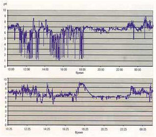 Рис. 3. рН-граммы больного до и после формирования пептической стриктуры (24-часовой мониторинг). 