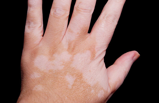 Ревматоидный артрит у женщин — Медицина 2.0