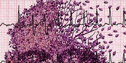 Нарушение ритма сердца резко увеличивает риск развития деменции — МедНовости