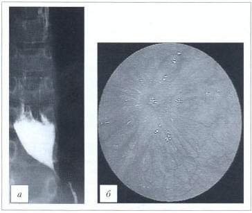 Рис. 3. Кардиоспазм II стадии. а - рентгенограмма; б - эндофото (данные ФГБНУ 