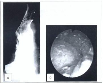 Рис. 5. Кардиоспазм IV стадии. а - рентгенограмма; б - эндофото (данные ФГБНУ «РНЦХ им. акад. Б.В. Петровского»)