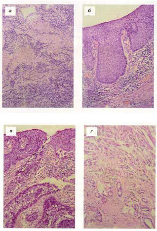 Рис. 1. Развитие рака в рубцовой стриктуре пищевода. Окраска гематоксилином и эозином