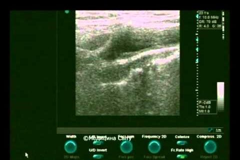 Измерение толщины интимы-медии сонной артерии