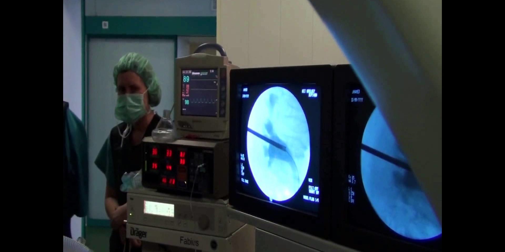 Перкутанная нефролитотрипсия