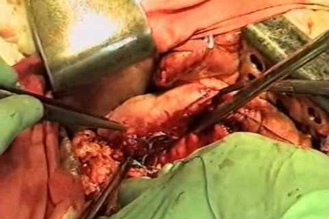 Резекция желудка-resection of the stomach