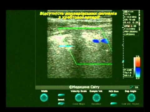 УЗИ позвоночных артерий