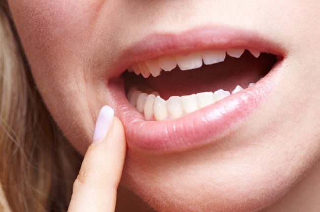 Ранние симптомы опухолей полости рта