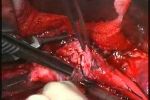 Операции на почечных и висцеральных артериях