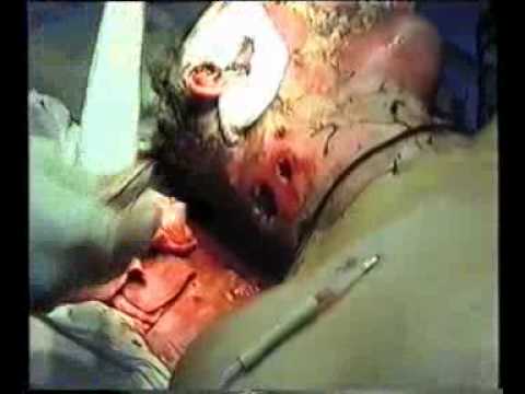Осколочная рана шеи-Fragmental wound of a neck