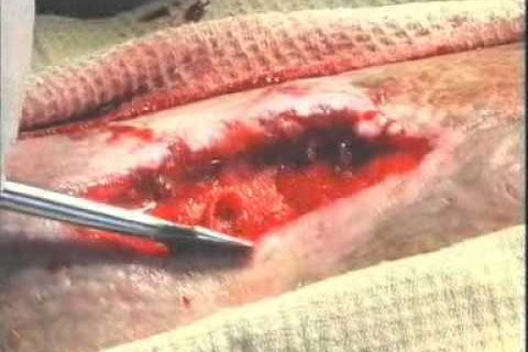 Остеомиелит — osteomyelitis