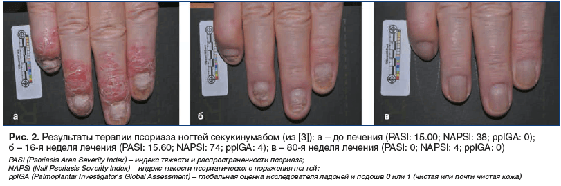 Рис. 2. Результаты терапии псориаза ногтей секукинумабом (из [3]): а – до лечения (PASI: 15.00; NAPSI: 38; ppIGA: 0); б – 16-я неделя лечения (PASI: 15.60; NAPSI: 74; ppIGA: 4); в – 80-я неделя лечения (PASI: 0; NAPSI: 4; ppIGA: 0)