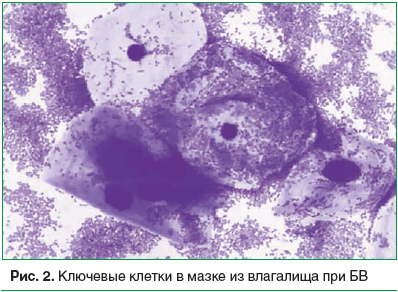 Рис. 2. Ключевые клетки в мазке из влагалища при БВ