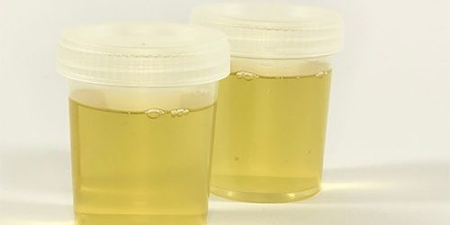 Стандартный диагностический тест при хроническом цистите оказался неэффективным — МедНовости