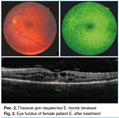 Рис. 2. Глазное дно пациентки Е. после лечения