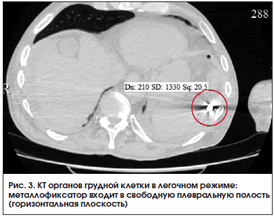 Рис. 3. КТ органов грудной клетки в легочном режиме: металлофиксатор входит в свободную плевральную полость (горизонтальная плоскость)