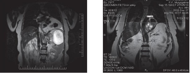 Рис. 3. МРТ диафрагмы, органов верхнего этажа брюшной полости