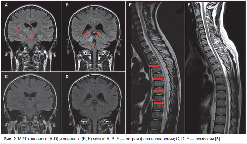 Рис. 2. МРТ головного (A-D) и спинного (E, F) мозга: A, B, E — острая фаза воспаления; C, D, F — ремиссия [5]