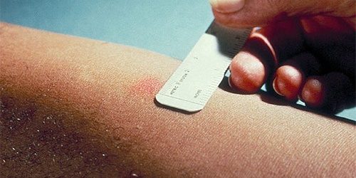 Проба Манту перестает быть монополистом — МедНовости