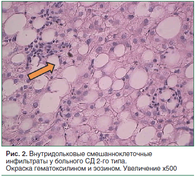Рис. 2. Внутридольковые смешанноклеточные инфильтраты у больного СД 2-го типа. Окраска гематоксилином и эозином. Увеличение х500