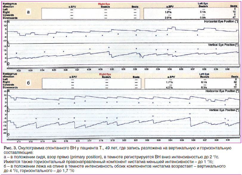 Рис. 3. Окулограмма спонтанного ВН у пациента Т., 49 лет, где запись разложена на вертикальную и горизонтальную составляющие