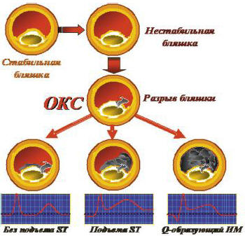 Рис. 3. Механизмы формирования различных форм ОКС